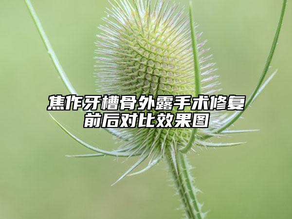焦作牙槽骨外露手術修復前后對比效果圖