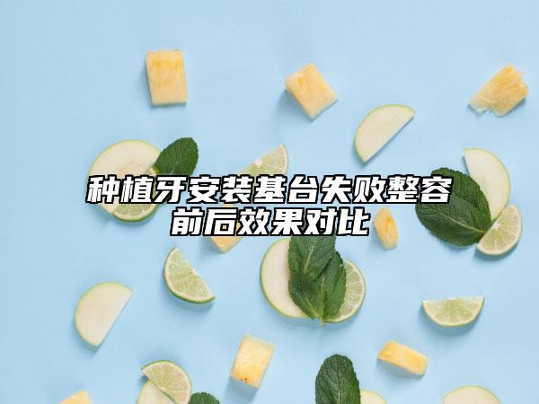 種植牙安裝基臺失敗整容前后效果對比