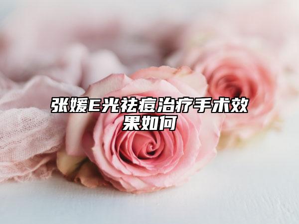 張媛E光祛痘治療手術效果如何