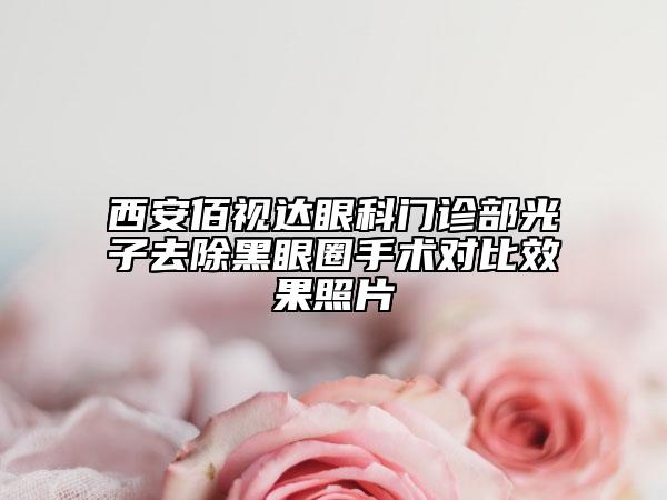 西安佰視達(dá)眼科門(mén)診部光子去除黑眼圈手術(shù)對(duì)比效果照片